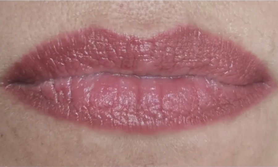 Lèvres rosées et contour net, après cicatrisation d'une bouche bisou