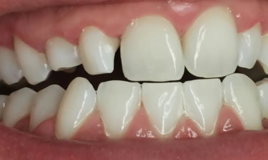 Dents blanchies vues de face après un blanchiment dentaire