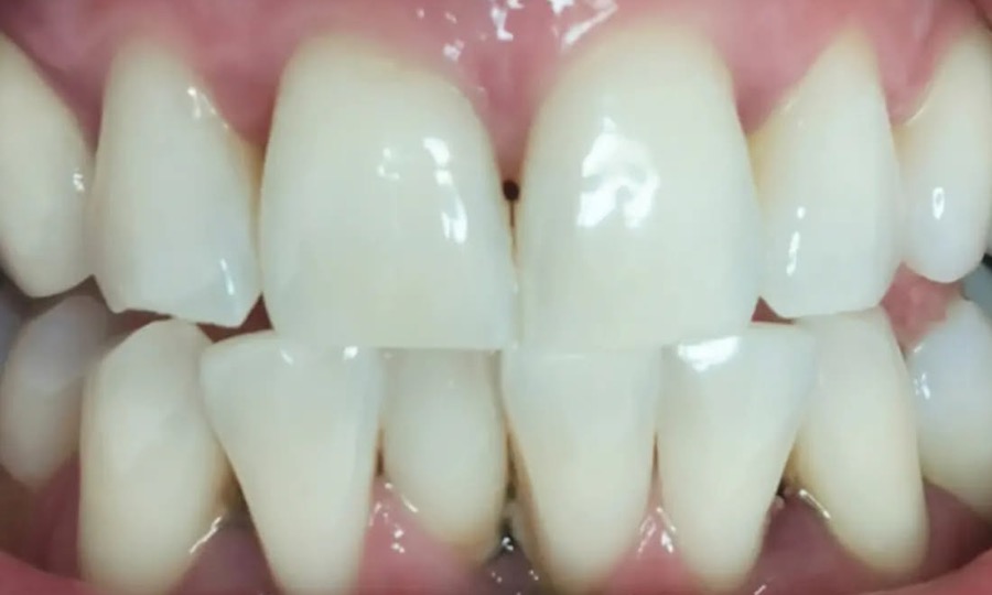 Sourire large aux dents blanchies après deux séances de blanchiment dentaire américain