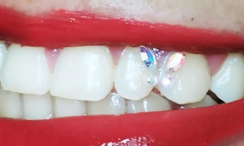 Sourire aux lèvres rouges, bijou dentaire Swarovski et strass supplémentaires sur deux dents
